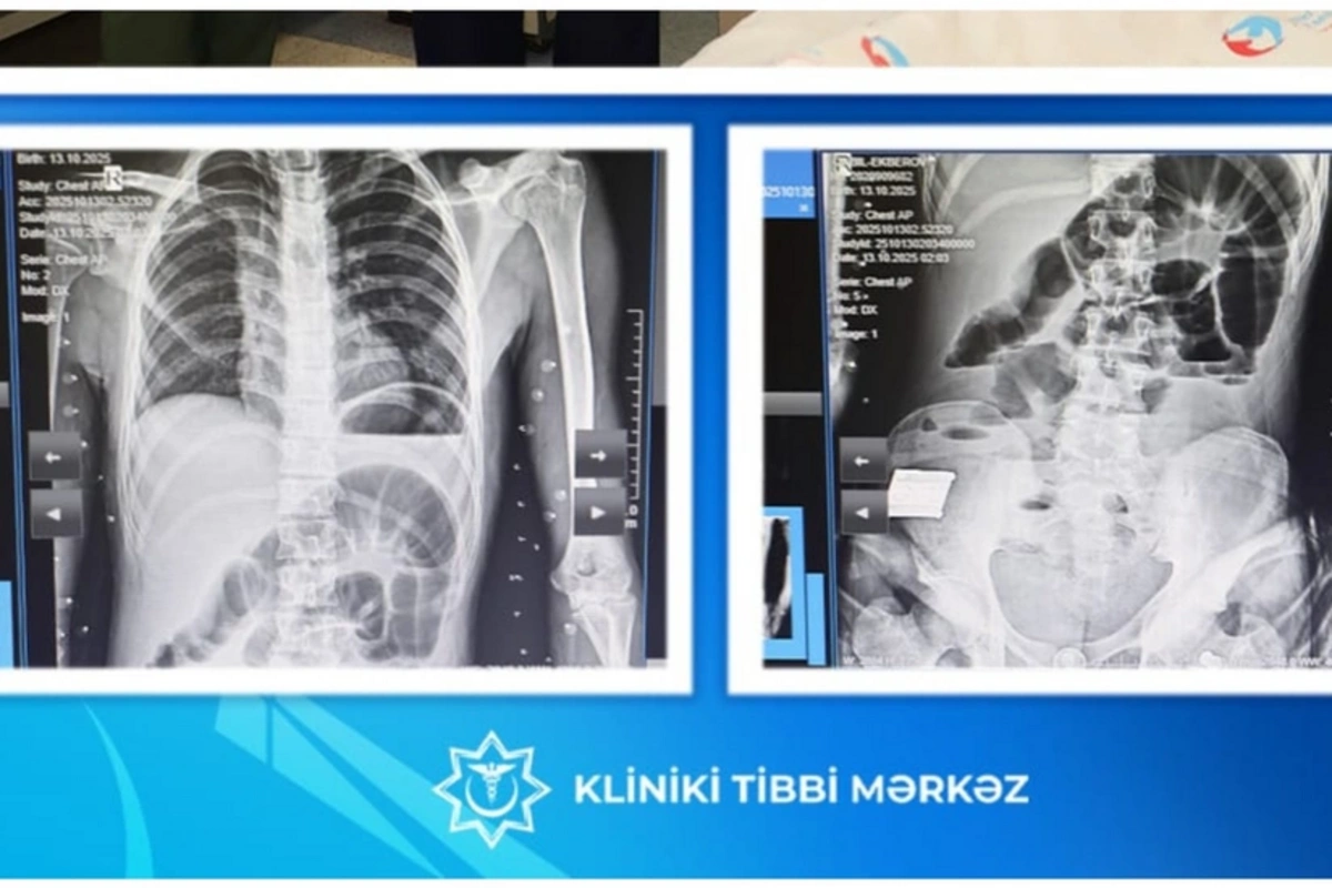 17 yaşlı yeniyetmənin bağırsağından taxta parçası çıxarıldı