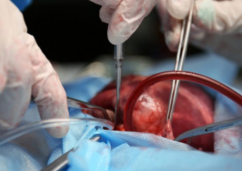 Ağciyər və qaraciyərin transplantasiyası metodu ilə müalicə zərurətinin təcililik statusuna dair meyarlar açıqlanıb Ağciyər və qaraciyərin transplantasiyası metodu ilə müalicə zərurətinin təcililik statusuna dair meyarlar açıqlanıb