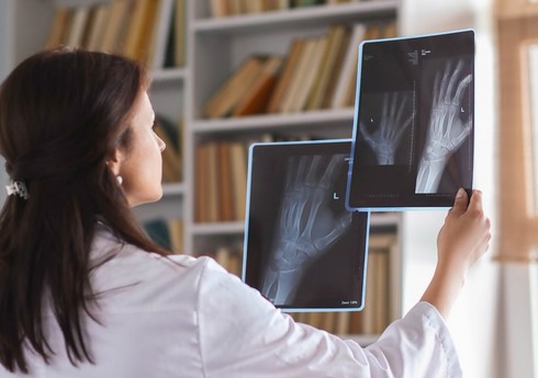 Alimlər sümük xərçəngi hüceyrələrinin effektiv məhvi üsulunu kəşf ediblər