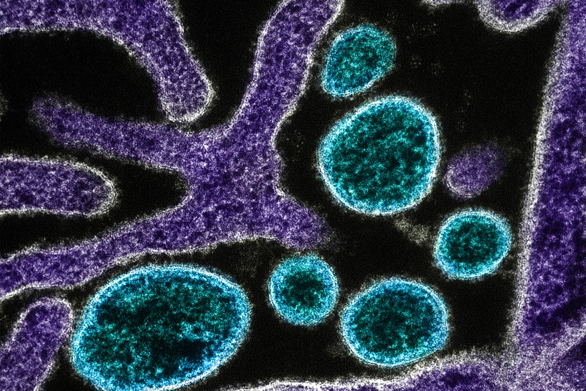 Bu ölkədə meymunçiçəyi virusu sürətlə yayılır – 302 yoluxma, 1 ölüm