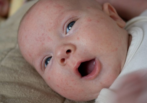 Dağıstanda qızılcaya 200-ə yaxın yoluxma halı müəyyən edilib