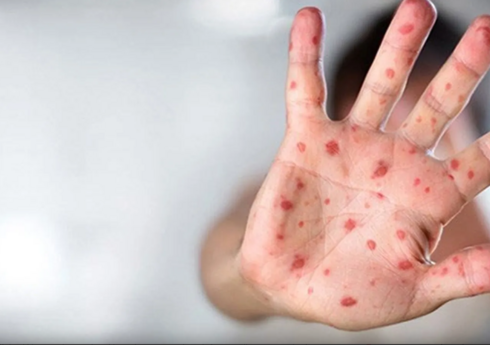 Dünyanın daha bir ölkəsində meymunçiçəyinə yoluxma aşkarlanlb