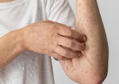 ​​​​​​​Ermənistanda qızılcaya yoluxma hallarının sayı kəskin artıb