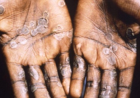 Çexiyada meymunçiçəyinə ilk yoluxma qeydə alınıb