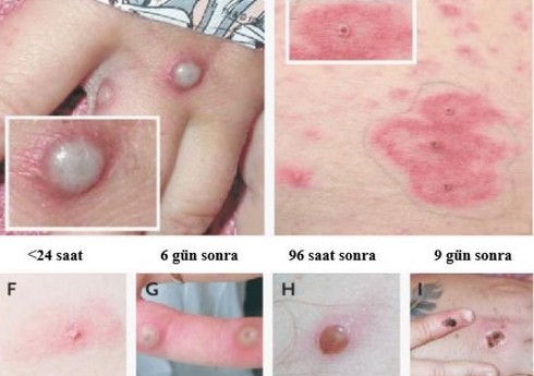 Misirdə meymunçiçəyi virusuna ilk yoluxma halı qeydə alınıb