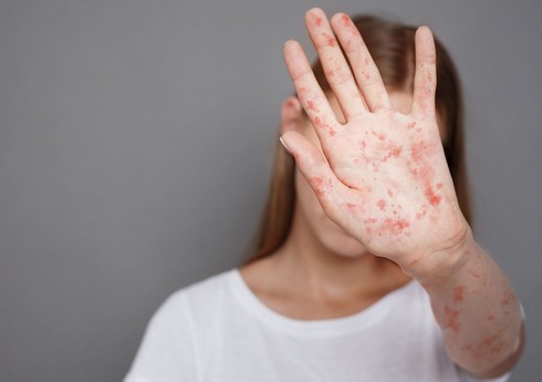 Məktəblərdə qızılca ilə bağlı son vəziyyət açıqlanıb