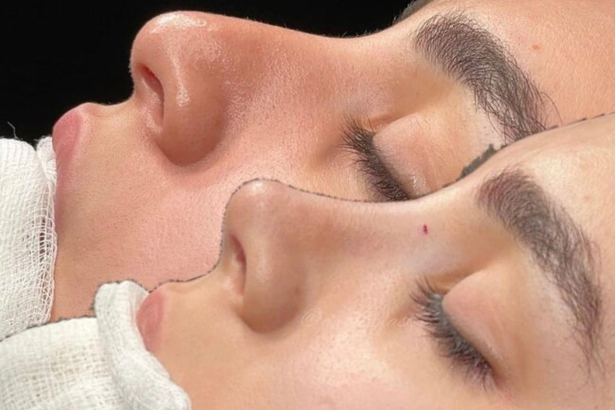 Nazirliyin siyahısına düşə bilməyən plastik cərrahları nə gözləyir? - Cinayət MƏSULİYYƏTİ VAR