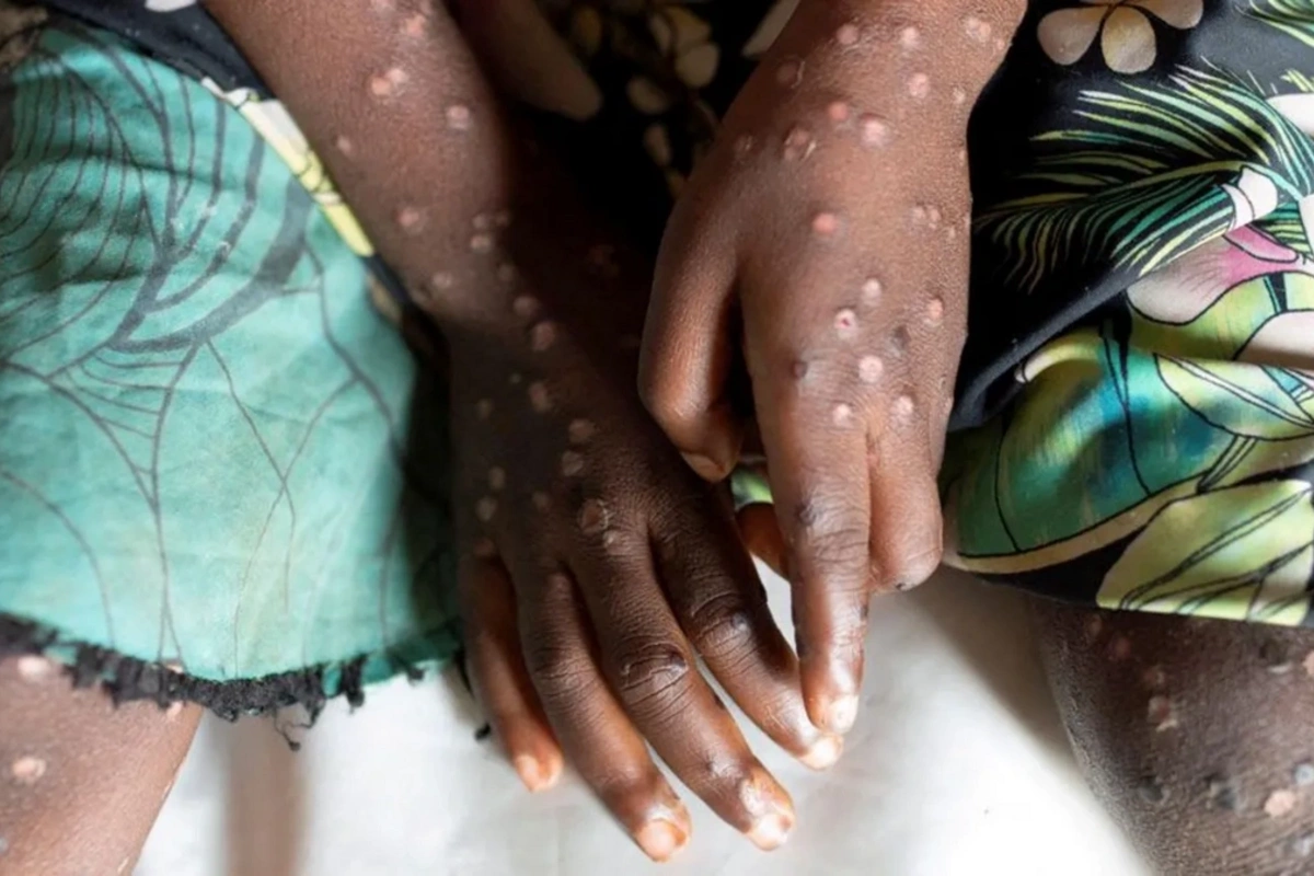 ÜST meymunçiçəyi ilə bağlı beynəlxalq fövqəladə hal rejimini ləğv etdi