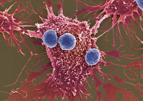 Xərçəng xəstəliyi şişlərinin məhvi üçün radioaktiv gel hazırlanıb