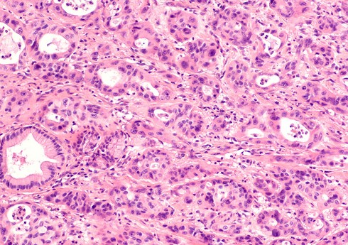 Xərçəngin inkişafına səbəb olan iki vitamin açıqlanıb