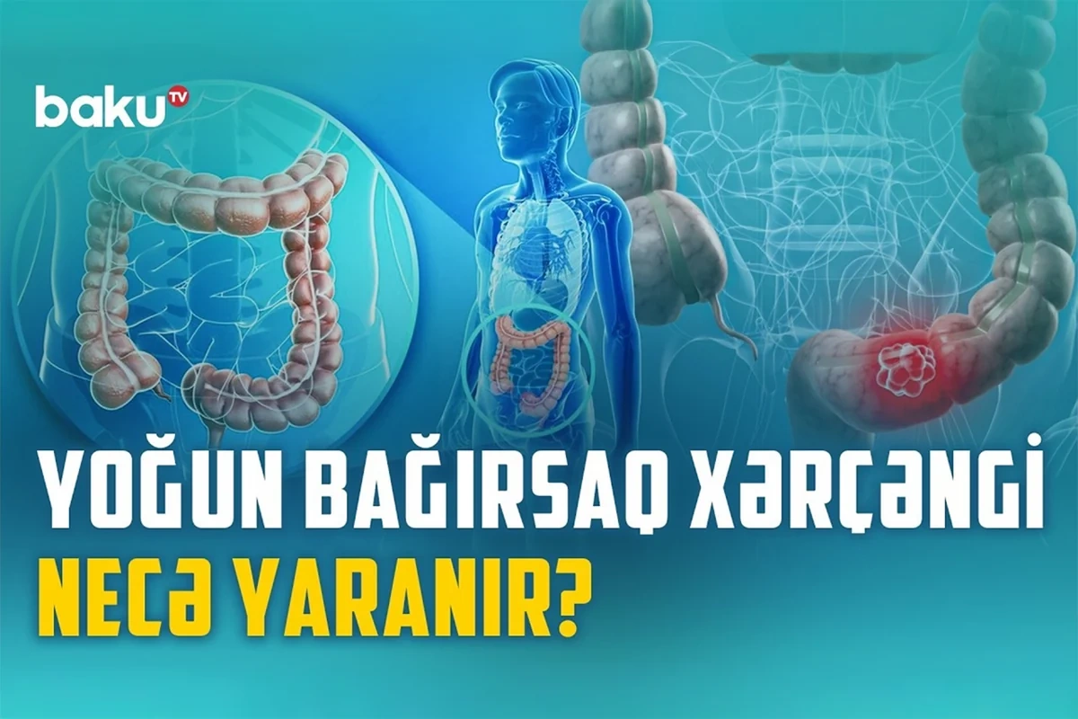 Yoğun bağırsaq xərçənginin qarşısını necə almaq olar?